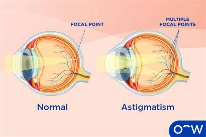 What is Astigmatism? (with pictures)